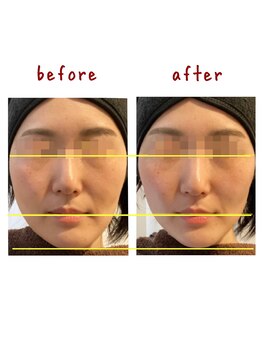 シンシンラボ 豪徳寺(SHINSHIN Lab)/鍼だけではない技術!