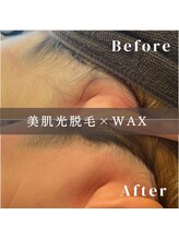 エピナ 横浜店(Epina)/うなじ脱毛/ブライダル脱毛