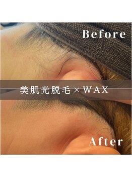 エピナ 横浜店(Epina)/うなじ脱毛/ブライダル脱毛