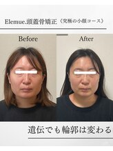 エレミュー(Elemue)/エラ張りスッキリ！12回施術