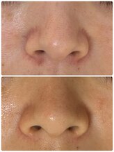 シュガー(Sugar...iyr)/ハーブピーリング