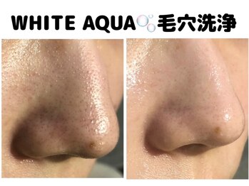 ホワイトアクア 柏店(WHITE AQUA)/ピーリング/肌トラブル改善