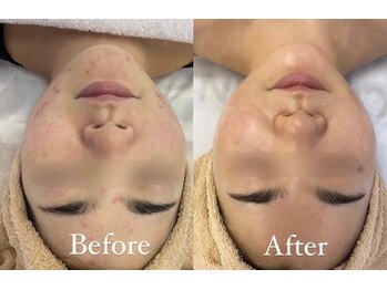 肌質改善専門【Salon da Mahina】毛穴ケア/ニキビケア/ハーブピーリング/ニキビ/毛穴/ハーブピーリング