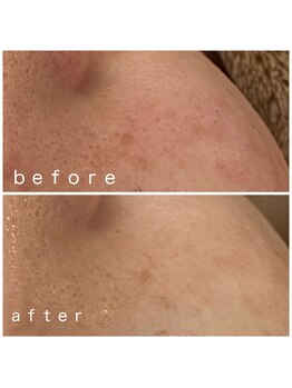 メナードフェイシャルサロン 岐阜茜部/美白&お肌の引き締め