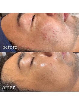 アースコアフュールボーテ ひたち野うしく店(EARTH coiffure beaute)/プラズマシャワー