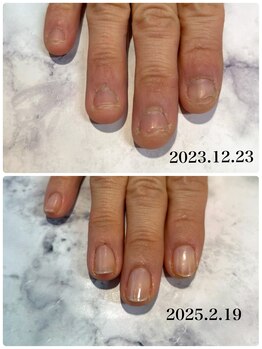 ネロリ(Neroli)/自爪育成 深爪