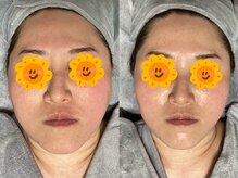 ホワイティアビシェル 浦和(Whitia Vishell)/北浦和駅西口シワたるみ改善