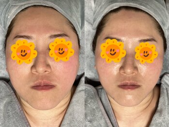 ホワイティアビシェル 浦和(Whitia Vishell)/北浦和駅西口シワたるみ改善