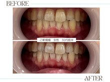 ホワイトニングサロンブライト 尼崎店(Whitening salon bright)/ご新規様のbefore/after