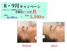30名様限定★たるみ・シワ改善◎ 根本改善!! 水素フェイシャル 水素吸入付♪