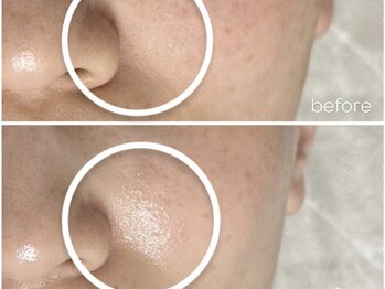 アンリミット 鹿児島天文館店(Une limit)/乳酸菌ピーリング