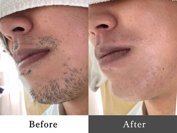 メンズオージー 岡山中区(men's O.G)/メンズ脱毛｜ひげ脱毛