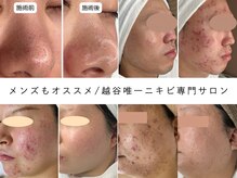ニキビケア、毛穴専門◎越谷/せんげん台/大宮/春日部/草加/