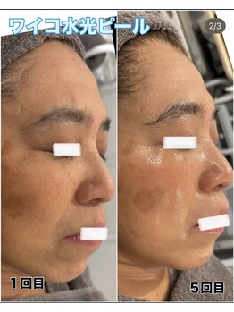 グレース(GRACE)/ワイコ水光ピール