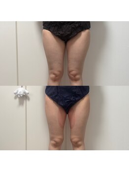 ミージュ(Miiju.)/美脚ケアにも脂肪冷却