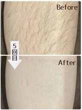 ルタンリッシュオム(Lutan Riche hom)/脚脱毛｜途中経過