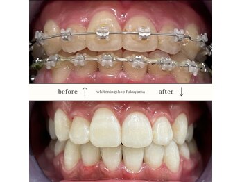 ホワイトニングショップ 福山店/矯正中の方でもホワイトニング◎
