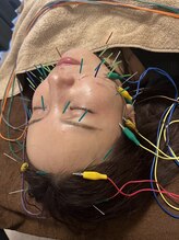 マル(malu)/美容鍼