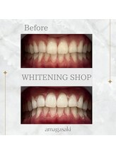 ホワイトニングショップ 尼崎店/セルフホワイトニング1回の効果