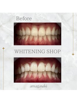 ホワイトニングショップ 尼崎店/セルフホワイトニング1回の効果