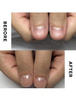 リミズネイルビューティー 名駅店(RimisNailxbeauty)/【美爪育成】深爪・噛み爪改善