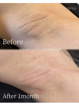 ラミパス(LAMIPAS)/ローマピンク症例　1ヶ月後