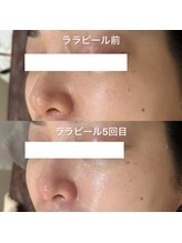 リラ(Lilas)/つるんと美肌/韓国肌へ