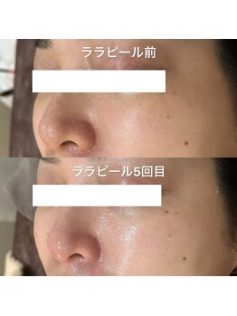 リラ(Lilas)/つるんと美肌/韓国肌へ