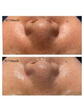 ベリル 金町店(Beryl)/黒いポツポツ、毛です！