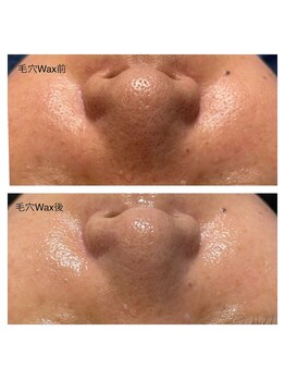 ベリル 金町店(Beryl)/黒いポツポツ、毛です！