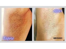 リボーン(Re bone)/脱毛デビューはReboneで