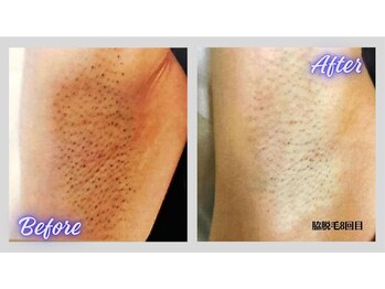 リボーン(Re bone)/脱毛デビューはReboneで