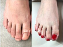アーティネイルズ(Aaty Nails)/【深爪矯正】フット