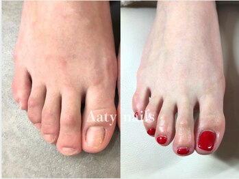 【深爪矯正】フット