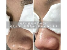 黒ずみ毛穴ケア専門店　melab　【ミラボ】〈毛穴エクストラクション/毛穴ケア〉の雰囲気（お顔全体に毛穴は約20万個！お顔全体の毛穴ケアでお肌に変化が♪）