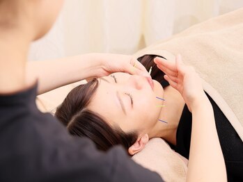 ラ コンシェル 星川店の写真/【毛穴の開き/黒ずみ/ニキビが気になる方へ…】美容鍼でお肌のターンオーバーをサポート!