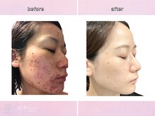 ホルバール 学芸大学店(Hallbar)の雰囲気（ターンオーバーを正常に整え肌荒れの原因を根本ケア※個人差あり）