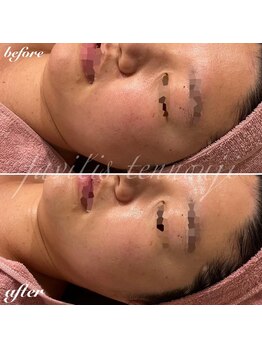 ファビリス 天王寺店(FAVILIS)/ACトリートメント+ハイドロ/30代