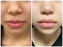 ビューティーモア(more)/ハーブピーリング3回目