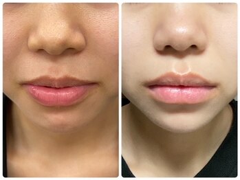 ビューティーモア(more)/ハーブピーリング3回目