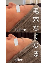 リノ(Lino)/プラズマフェイシャル