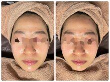 リボディ プラチナ(Rebody platinum)/小顔リフェイスコラーゲンリフト