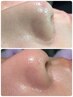 【見たことない毛穴汚れごっそり】韓国で大人気新施術☆毛穴洗浄コース/ツヤ