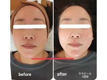 エム(M)/ララピール