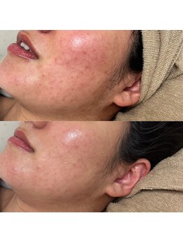 アンドミー(and me)/鹿児島/唐湊/毛穴洗浄/毛穴ケア