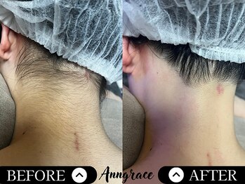 アングレイス(Anngrace)/【お顔脱毛うなじ】Before/After