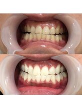 セルフメイド 石巻店/ホワイトニングビフォーアフター