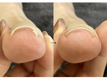 ロンディネ(Rondine)/巻き爪ケア&インペントプラス29