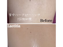 レティティア(Laetitia)/症例5【背中ハーブピーリング】