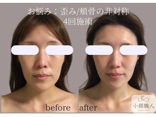 小顔職人/小顔ビフォーアフター/20代